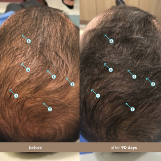 Serum con Nanoxidil 5% para el cabello