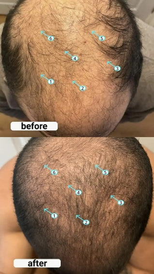 Serum con Nanoxidil 5% para el cabello